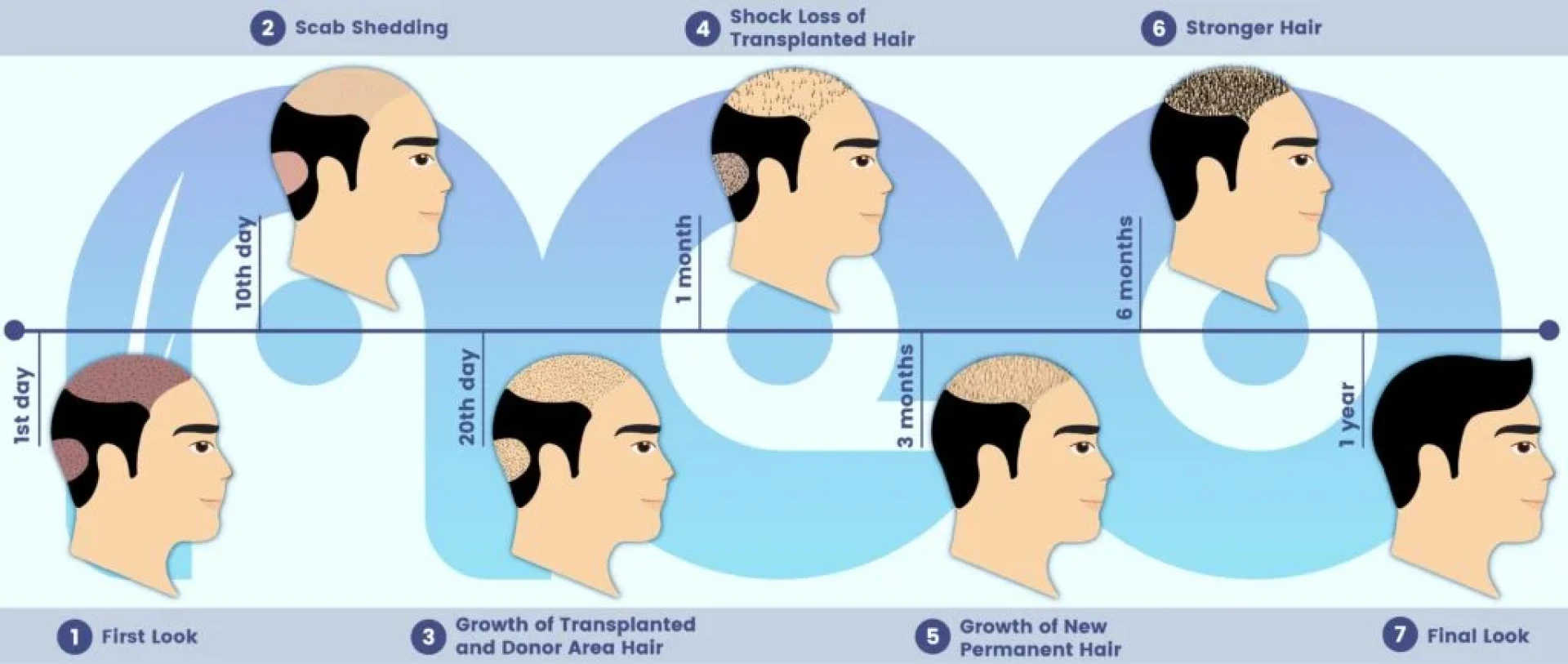 Hair Replacement in Turkey: A Transformative Solution for Hair Loss