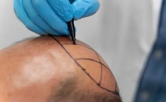 Top Questions About FUE Hair Transplant Answered