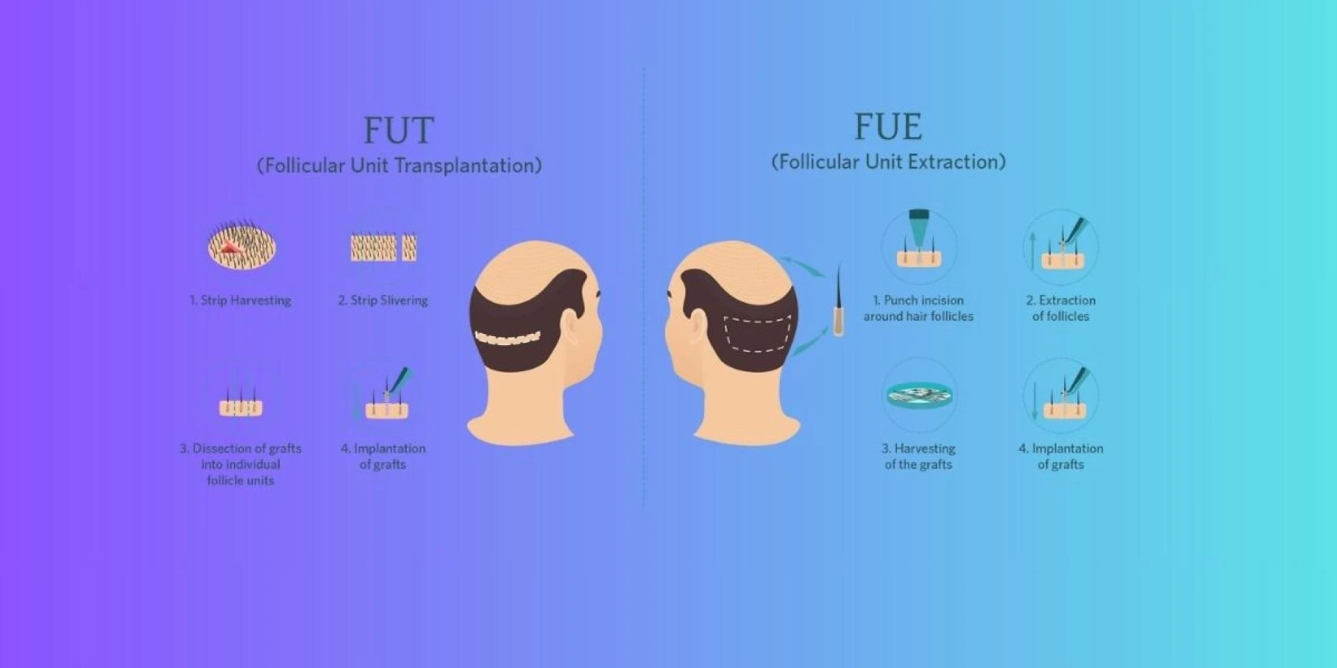 Top Questions About FUE Hair Transplant Answered