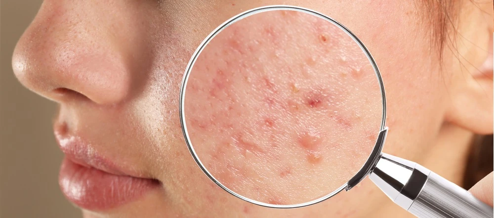 What are the Effective Treatments for Acne Scars?