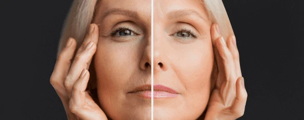 What are the Effective Treatments for Acne Scars?