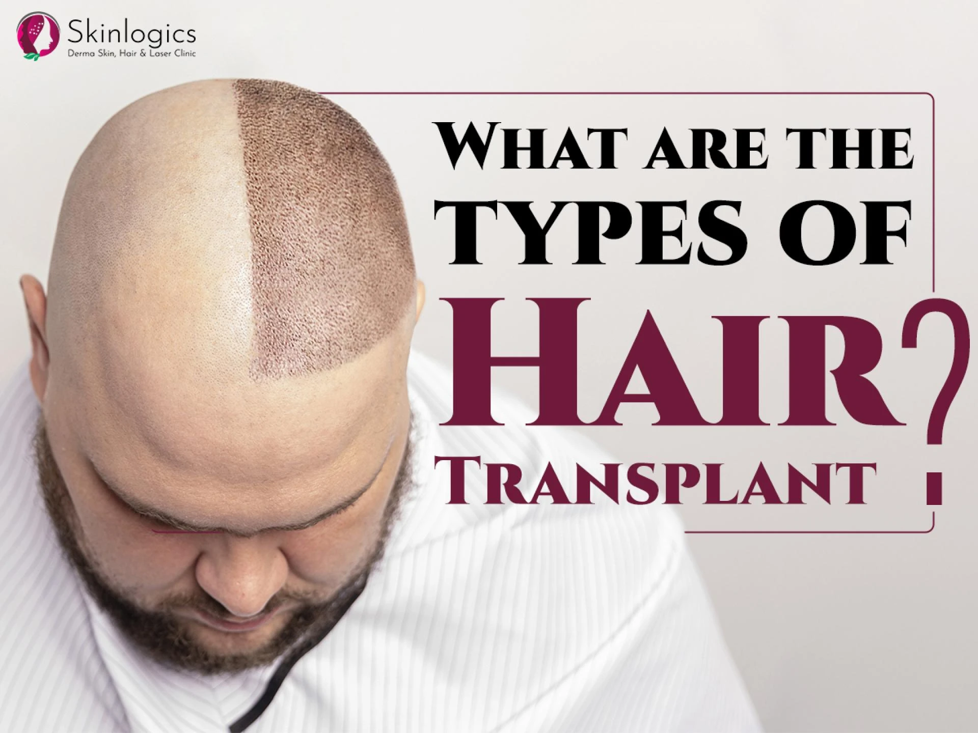 Hair Transplant Surgery Explained: Procedure, Benefits, and Results