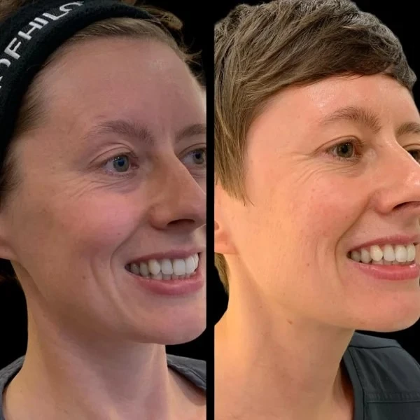 Nourish & Revitalize with Profhilo Treatments in Dubai