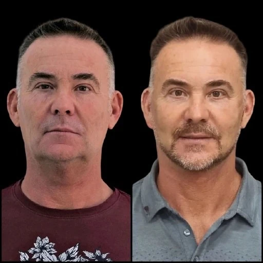 Achieve Skin Harmony via Profhilo in Dubai