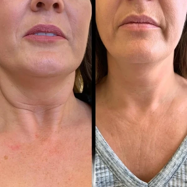 Boost Luminosity through Profhilo and the Best Doctors in dubai