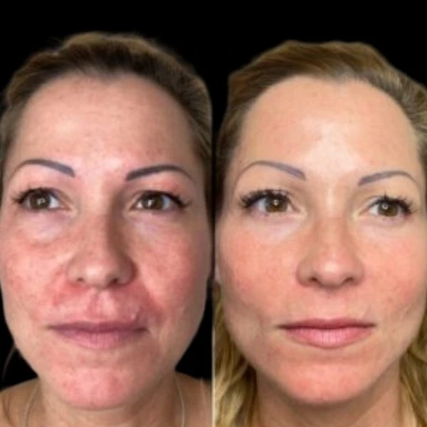 Grasp Youthful Results via Profhilo with the Best Doctors in dubai