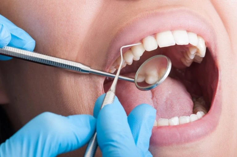 How Scaling and Root Planing Helps Treat Gum Disease ?