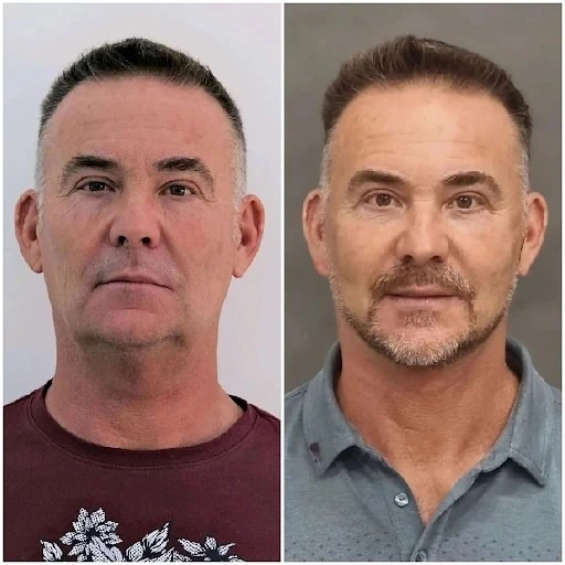 Frame Fresh Skin Tone with Profhilo in Dubai