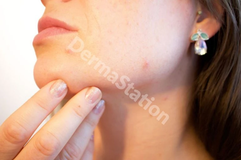 Best Acne Scar Treatment in Delhi – Get Results That Last