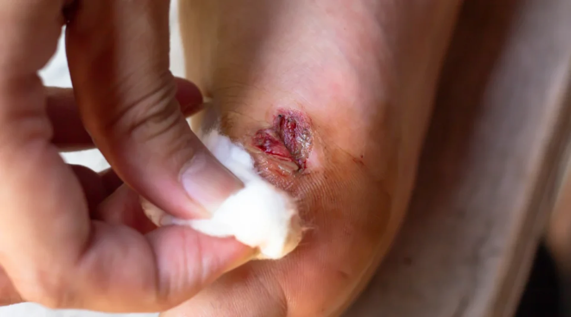 Understanding the Risks of a Non Healing Wound