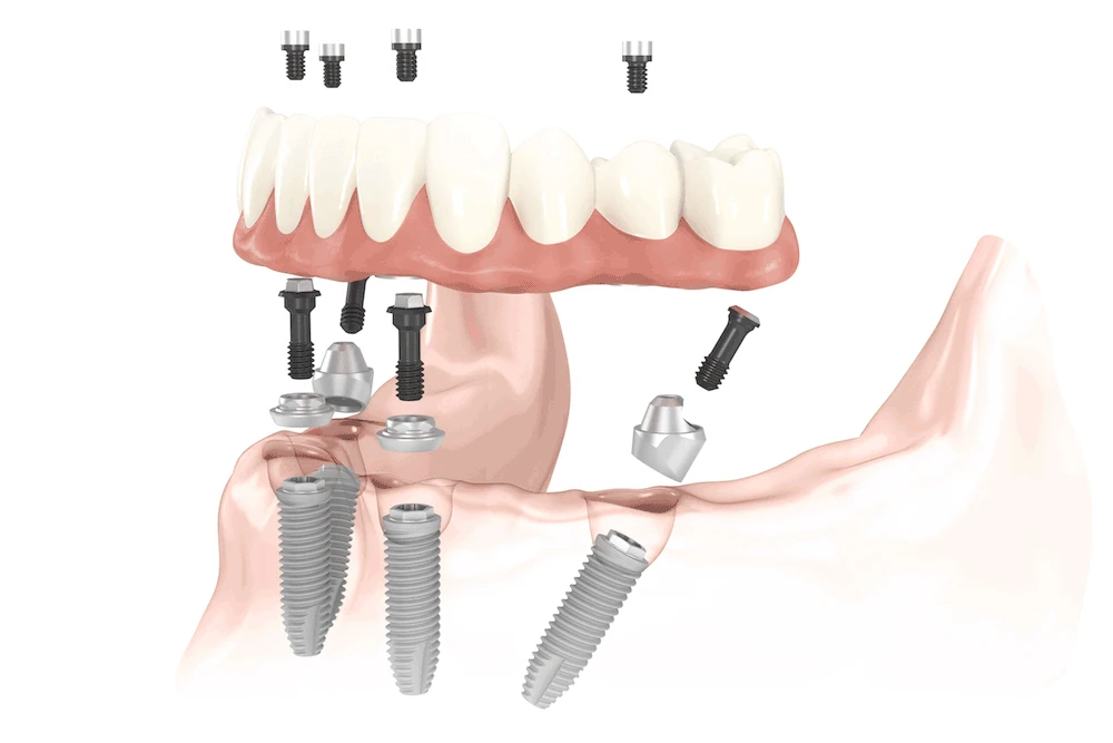Restore Your Smile with Dental Implants: A San Diego Dentist’s Guide