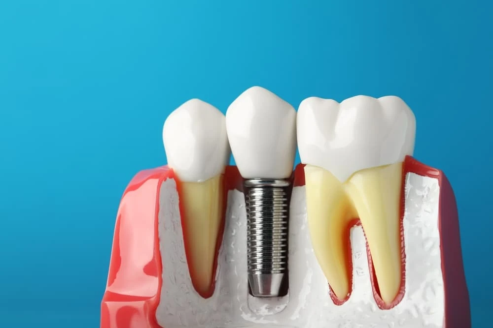 Are Dental Implants Painful?