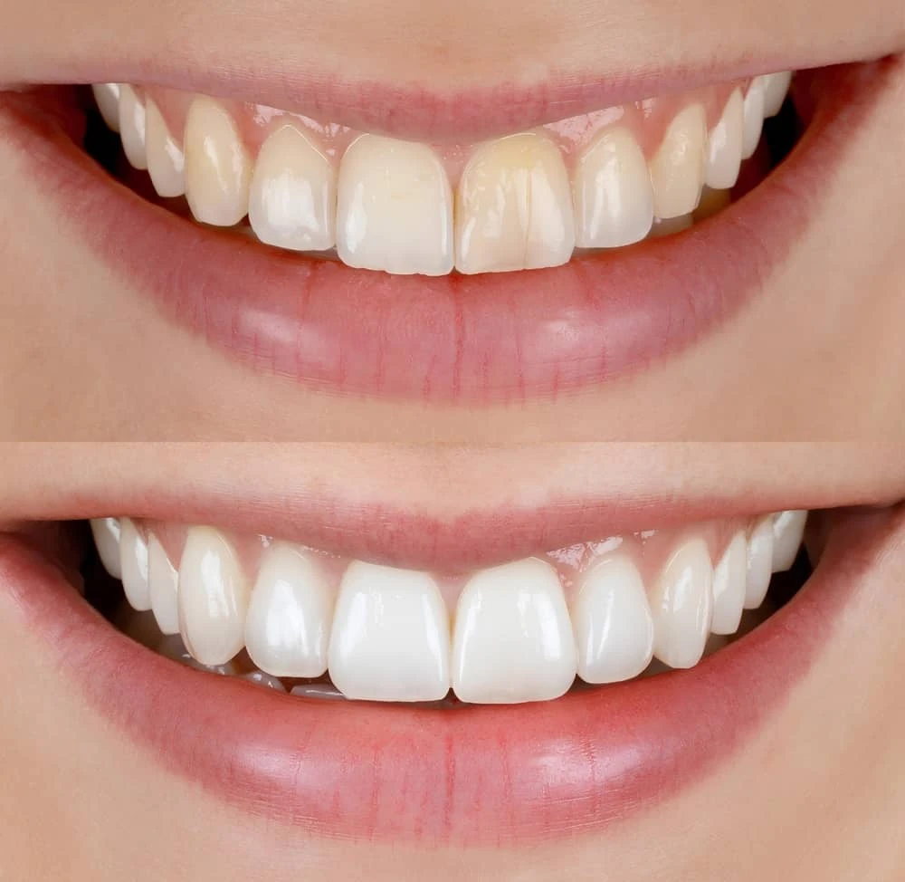 7 Signs You Might Be Ready for a Smile Makeover