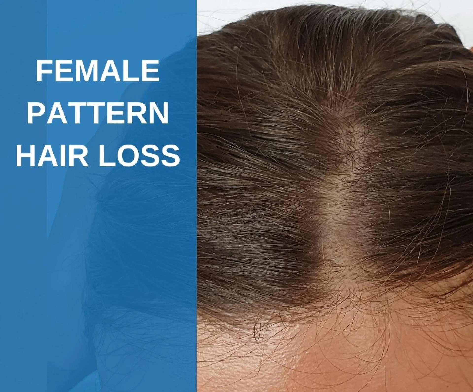 Bicalutamide for FPHL: Safe and Effective Hair Loss Treatment in Delhi