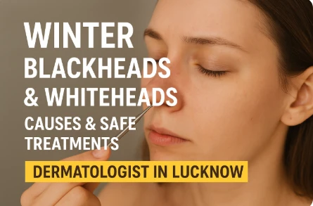 Winter Blackheads & Whiteheads: Why They Increase and How to Treat Them Safely