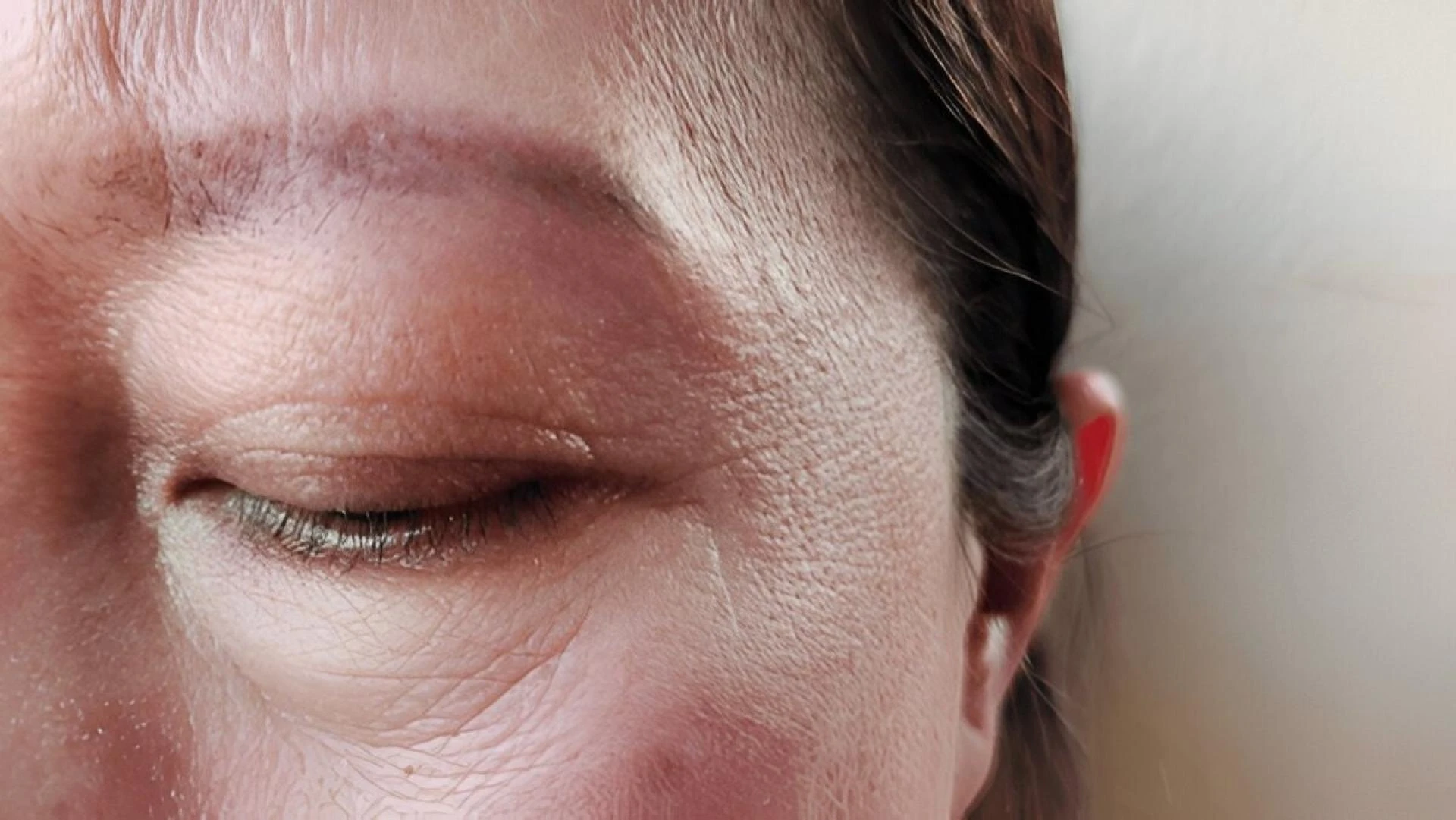 Why Do Wrinkles Form? Causes, Prevention & Treatments